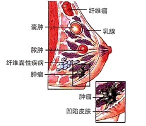 女性乳房纤维瘤一般情况下会长在乳房什么地方