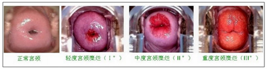 患了宫颈糜烂的的宫颈比较