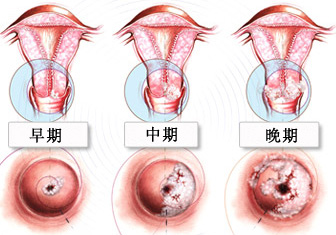 宫颈癌病理解析