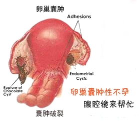 点击咨询治疗卵巢囊肿的方法