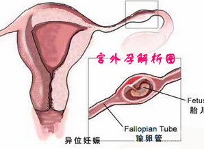 华济专家简述：宫外孕复发的原因