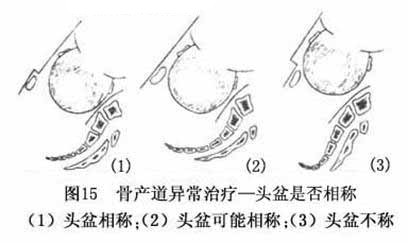 这样的妈妈容易顺产