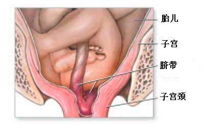 什么叫脐带脱垂?宝鸡妈妈如何预防脐带脱垂?