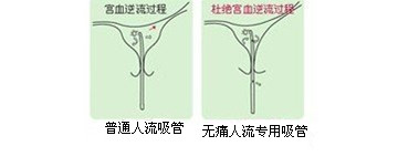 人流后出血过多,小心是绒毛膜癌来袭