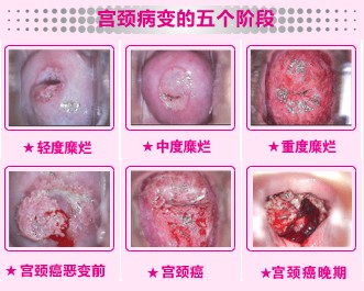 宝鸡治疗宫颈糜烂的价格是多少