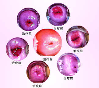 患了宫颈糜烂一定要手术吗?