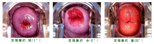 不同程度的宫颈糜烂该如何治疗?