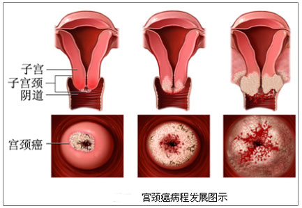 常见的宫颈炎危害