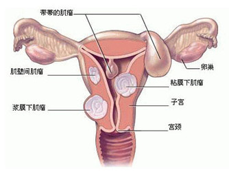 宝鸡哪家医院治疗子宫肌瘤好?